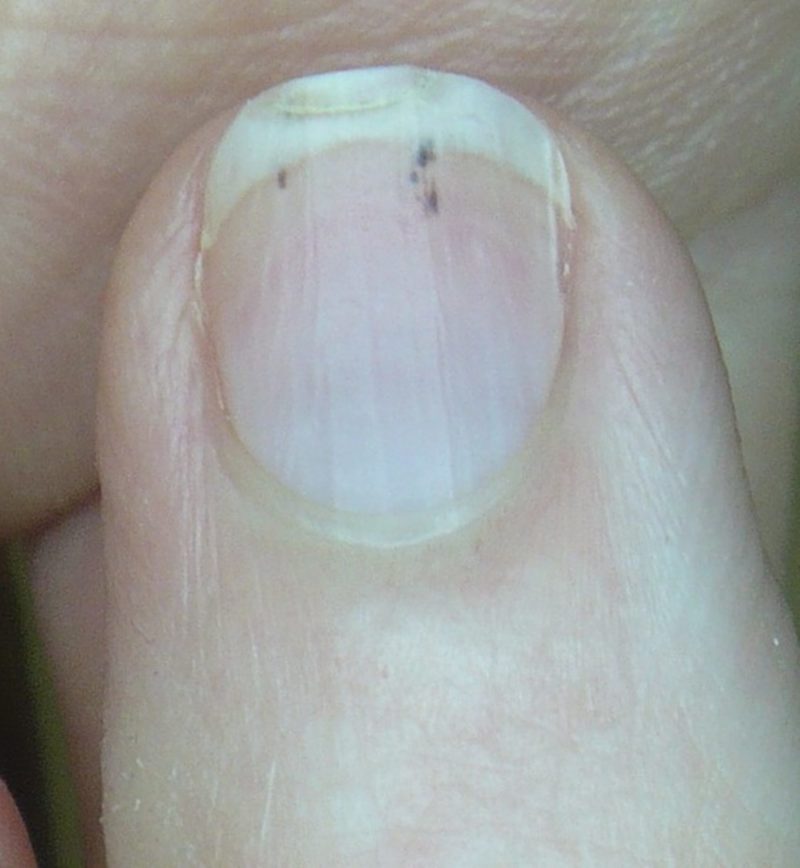 Splinterhemorrhage • NeoVista®