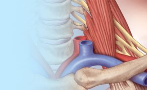 Thoracic outlet syndrome treatment