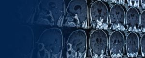 MRI Thoracic Outlet Syndrome Diagnosis