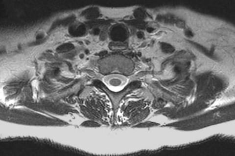 Axial MRI T1 Nerve Roots