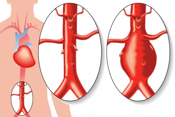 Aorta Normal vs Aneurysm