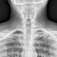 Cervical rib and elongated C7 transverse process