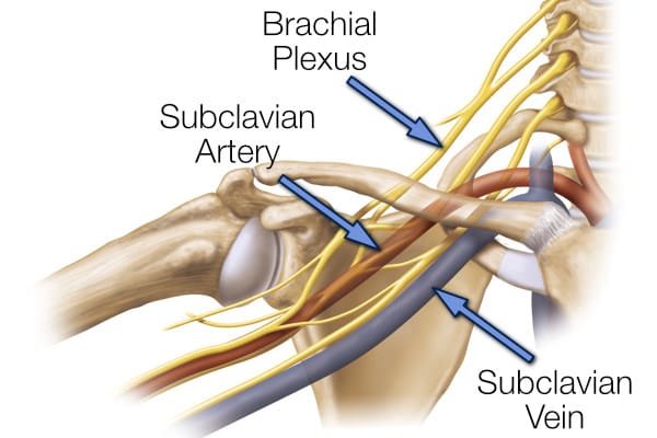 Symptoms of thoracic outlet syndrome result from compression of the brachial plexus, subclavian artery, and subclavian vein