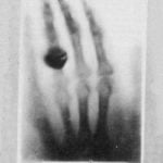 History of Thoracic Outlet Syndrome: Wilhelm Conrad Roentgen