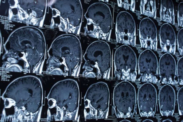 MRI Brain Perspective Cropped Imaging diagnosis of venous TOS