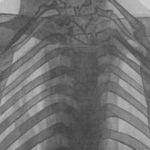 History of Thoracic Outlet Syndrome: H. Lewis Jones