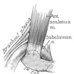 History of Thoracic Outlet Syndrome: Thomas Murphy