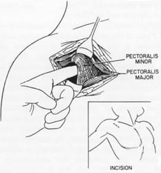 History of Thoracic Outlet Syndrome: Jere Lord and Peter Stone