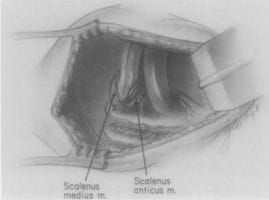 History of Thoracic Outlet Syndrome: Makhoul and Machleder