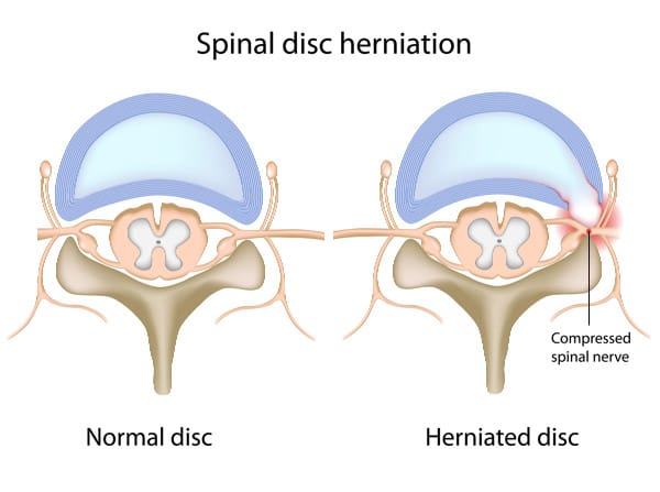 Herniation nerve entrapment