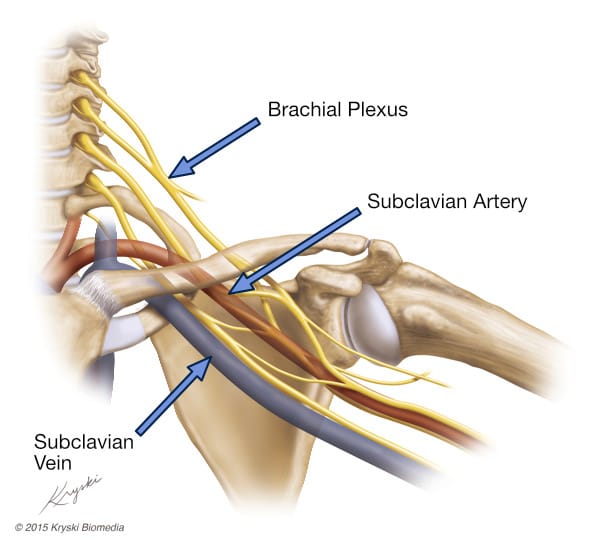 Kryski thoracic outlet vital structures TOS Anatomy Plexus, Vein and Artery