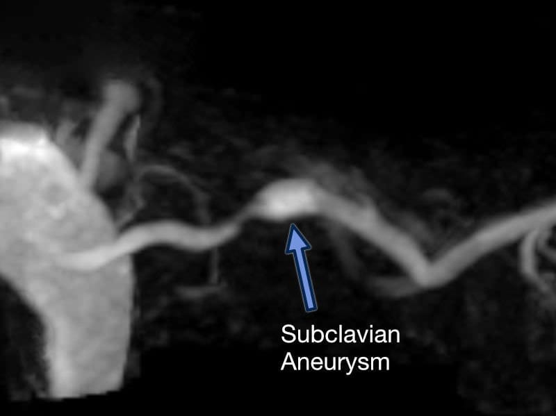 TOS Case Studies-Delayed Diagnosis of Thoracic Outlet Syndrome