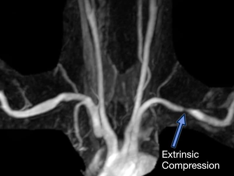 TOS Case Studies-Delayed Diagnosis of Thoracic Outlet Syndrome