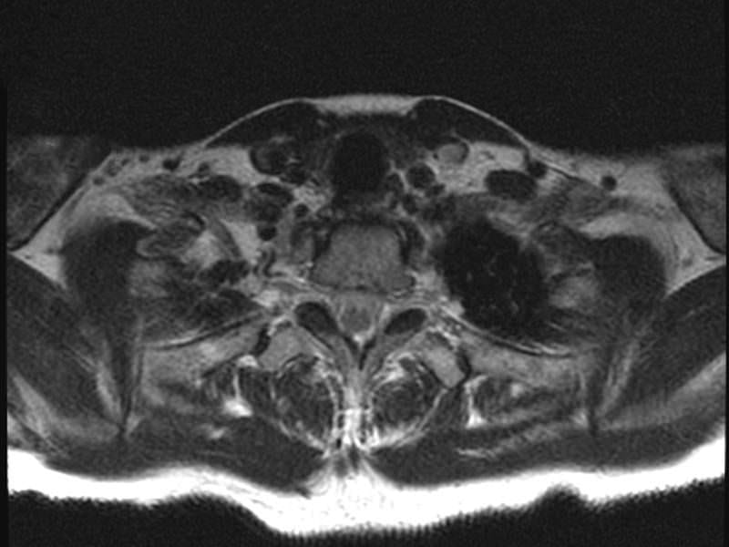 TOS Case Studies-Delayed Diagnosis of Thoracic Outlet Syndrome