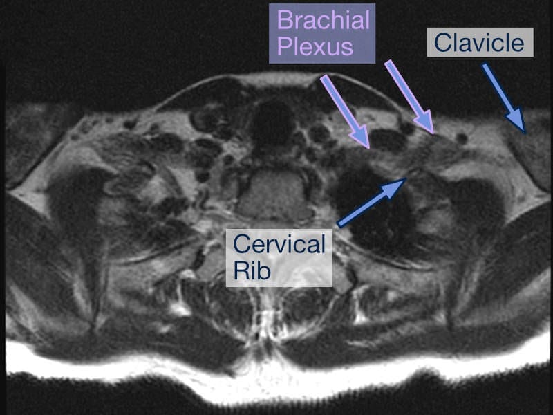 TOS Case Studies-Delayed Diagnosis of Thoracic Outlet Syndrome