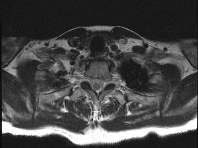 TOS Case Studies-Delayed Diagnosis of Thoracic Outlet Syndrome