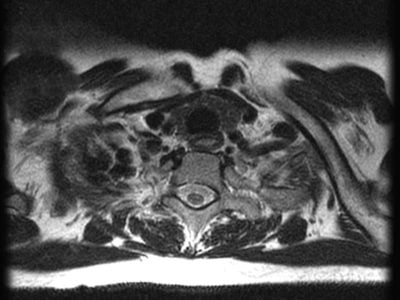 TOS Case Studies-Delayed Diagnosis of Thoracic Outlet Syndrome