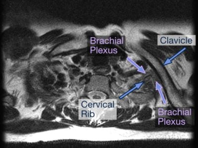 TOS Case Studies-Delayed Diagnosis of Thoracic Outlet Syndrome