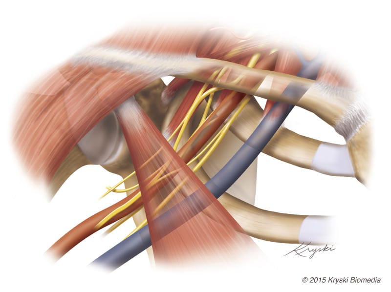 Brachial plexus, subclavian artery, and subclavian vein pass through the costoclavicular interval and retropectoralis space.