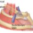 Reddit discussion on blood clots and purported diagnosis of venous TOS