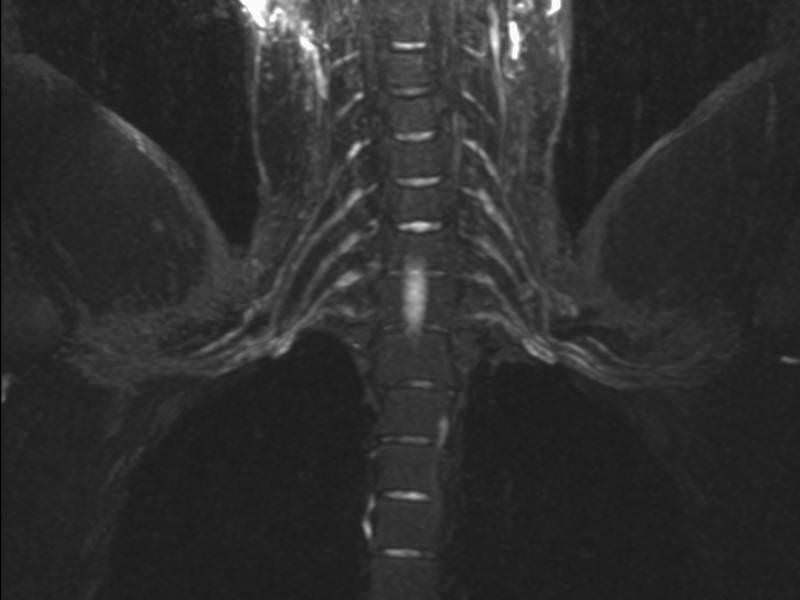Thoracic outlet syndrome test-MRI brachial plexus