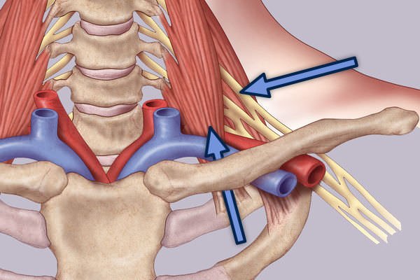 Normal AP Cropped Final-Combined Approach Surgical Treatment of Thoracic Outlet Syndrome-Transaxillary Approach