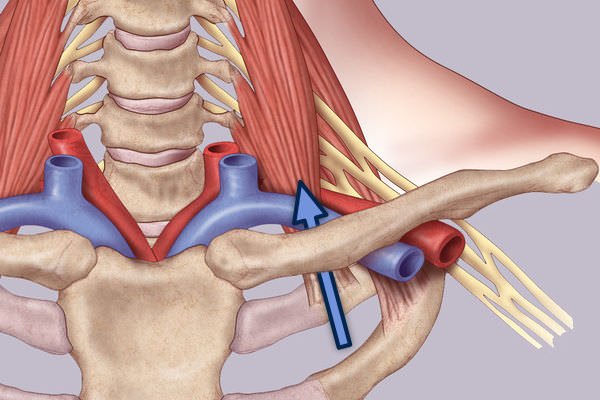Normal AP Cropped Final-Infraclavicular Approach Surgical Treatment of Thoracic Outlet Syndrome-Infraclavicular Approach