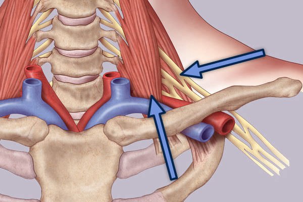 Normal AP Cropped Final-Supraclavicular Approach Surgical Treatment of Thoracic Outlet Syndrome-Supraclavicular Approach
