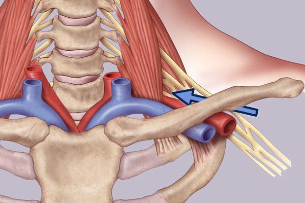 Normal AP Cropped Final-Transaxillary Approach Surgical Treatment of Thoracic Outlet Syndrome-Transaxillary Approach
