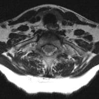 Axial MRI TOS