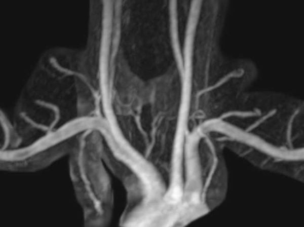 Imaging diagnosis arterial TOS normal MRA
