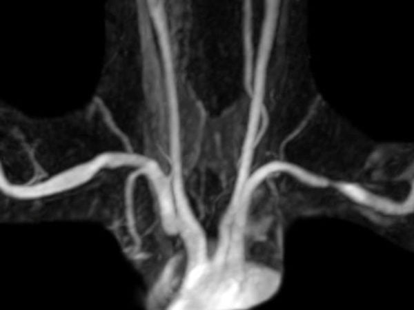 Imaging diagnosis arterial TOS MRA bilateral compression