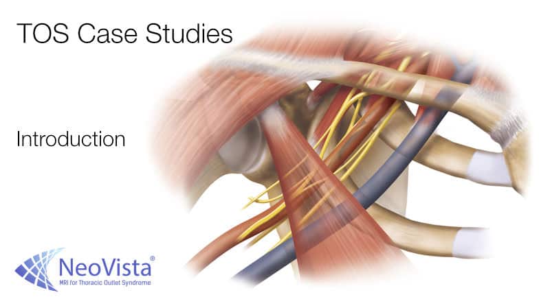 TOS Case Studies-Specific, detailed educational thoracic outlet syndrome cases