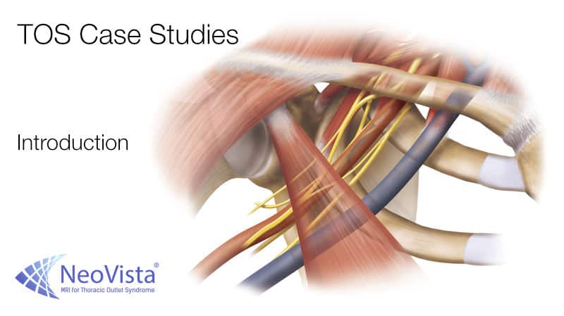TOS Case Studies TOS Case Studies-Specific, detailed educational thoracic outlet syndrome cases