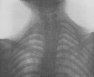 Cervical Rib Radiograph