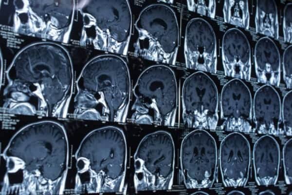 Neurogenic Thoracic Outlet Syndrome-MRI image sheet