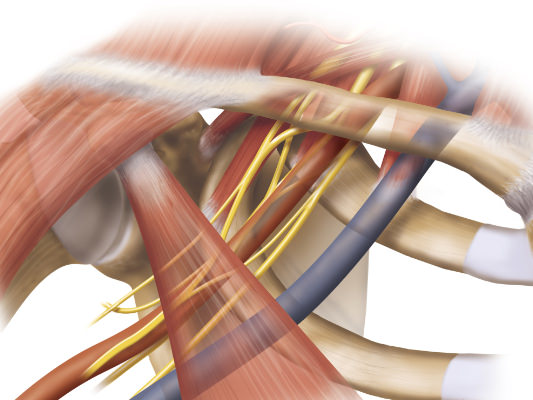 Causes of venous thoracic outlet syndrome Thoracic Outlet Syndrome
