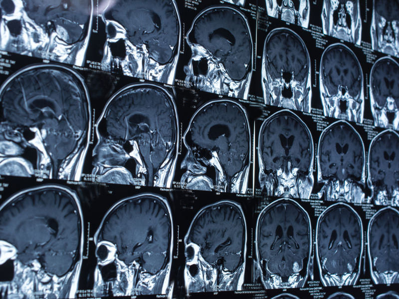 MRI Brain Perspective